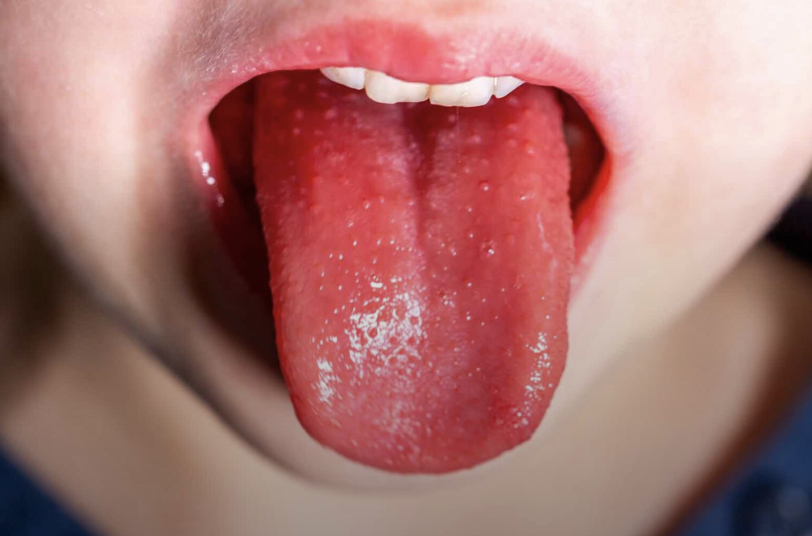 Group A Strep & Scarlet Fever